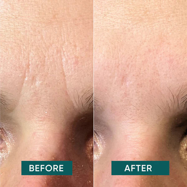 *Down the frown' - Gezichtspatches met hyaluronzuur - Apricot Beauty